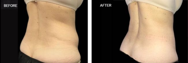 Body Contouring With Coolsculpting Before and After - Patient 28
